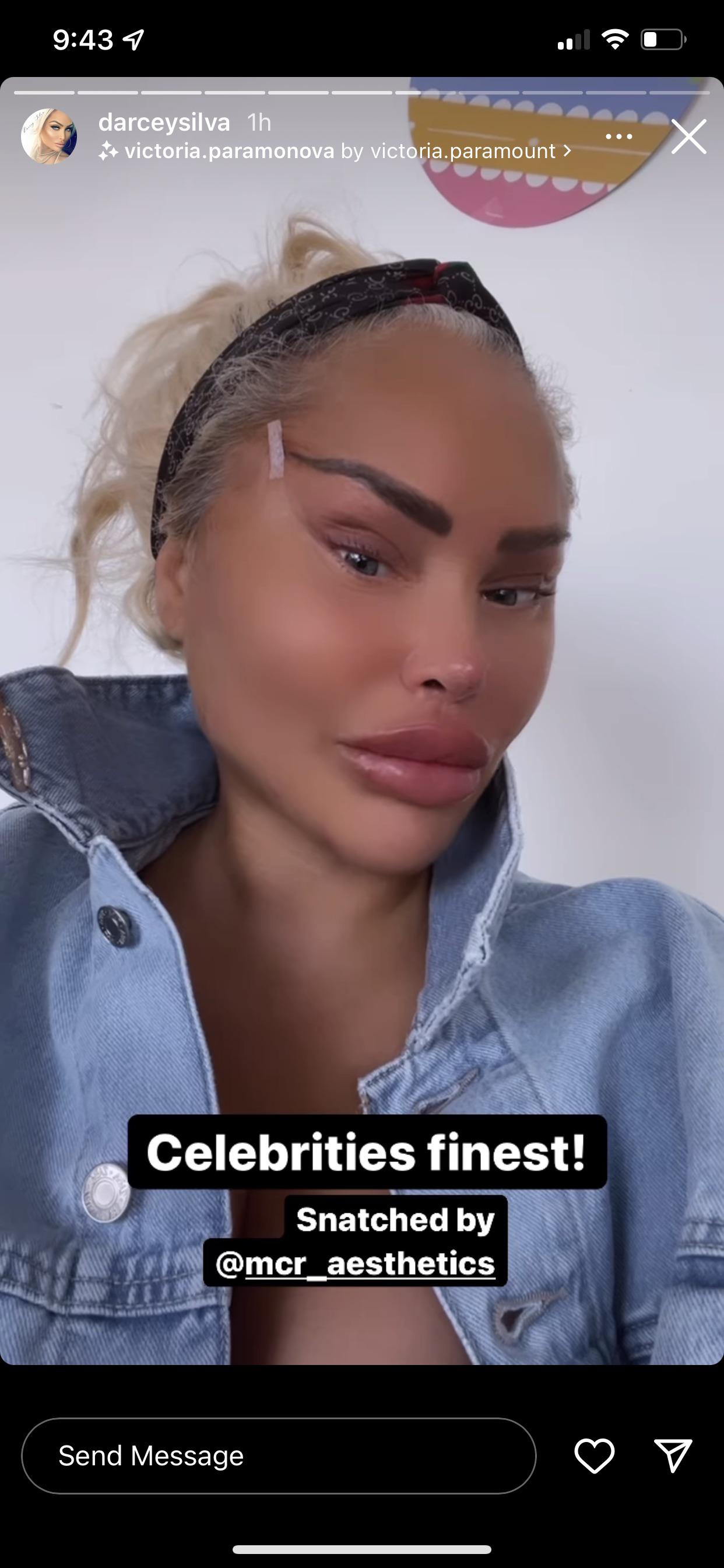 Celebs with brow lift