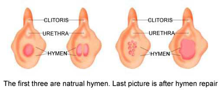 Gambar Selaput Dara Yang Masih Utuh - Tempat Berbagi Gambar