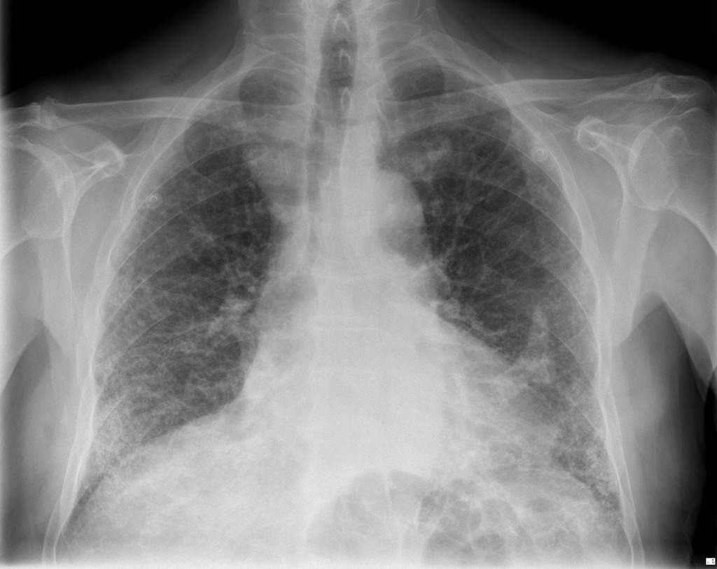 Asbestosis : Penyebab – Gejala dan Pengobatan - IDN Medis