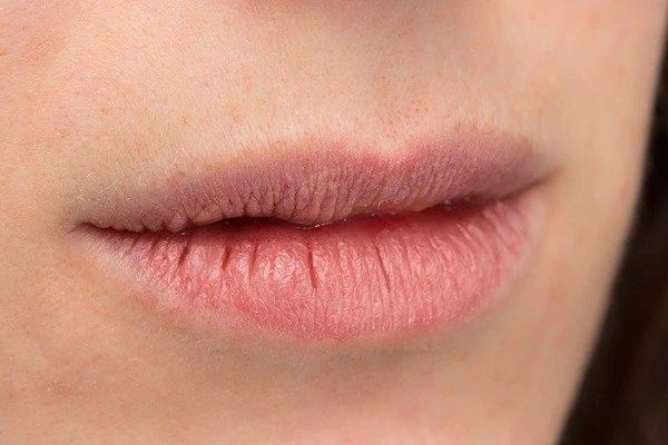 Obat Alami Untuk Mengatasi Bibir Pecah-pecah, Wajib Tahu