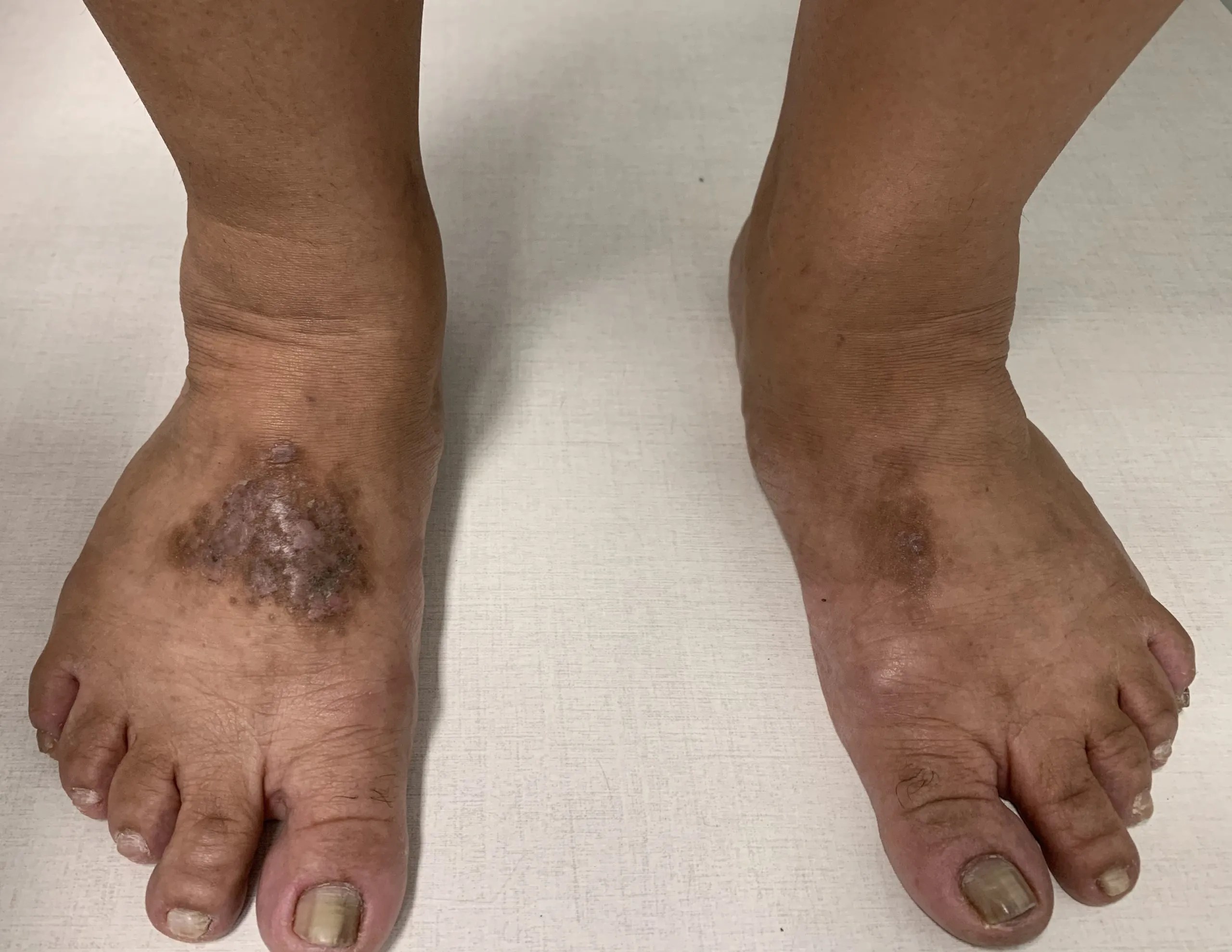 Mancha escura na sola do pé