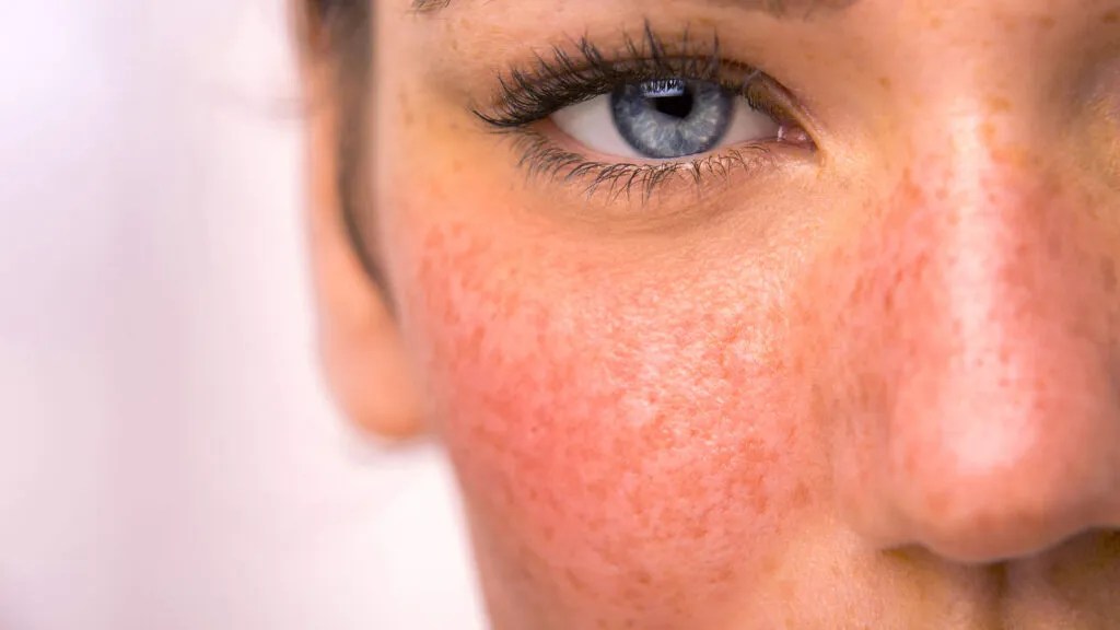 Mengenal Rosacea yang Kerap Disangka Jerawat