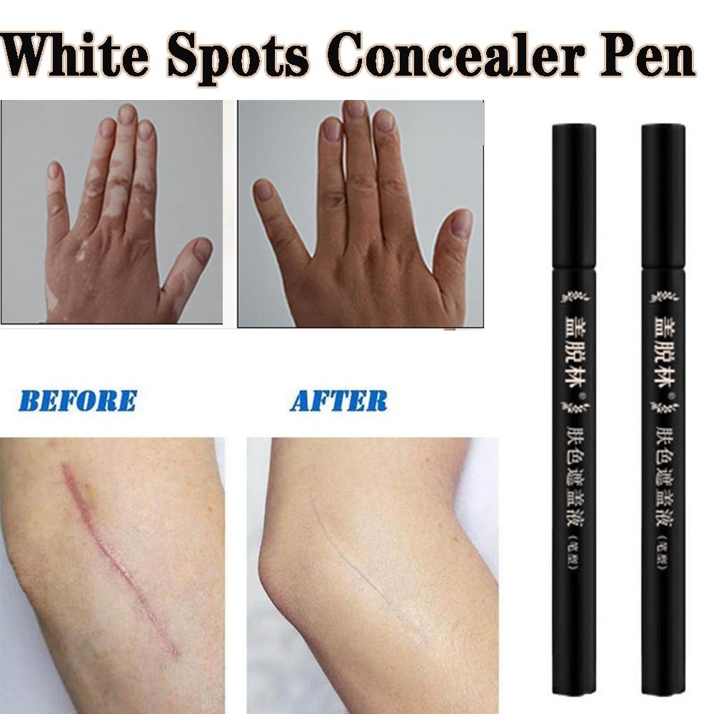 Buy Use White Spots Concealer Vitiligo Scars Cover Pen Camouflage Makeup Tattoo Concealer Liquid At Affordable Prices — Free Shipping, Real Reviews With Photos — Joom 1000_x_1000_jpg