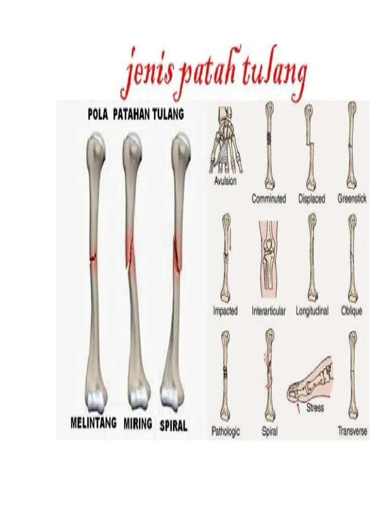 Jenis Jenis Patah Tulang | PDF