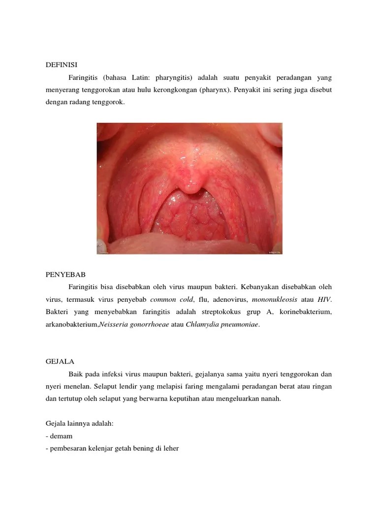 Faringitis | PDF