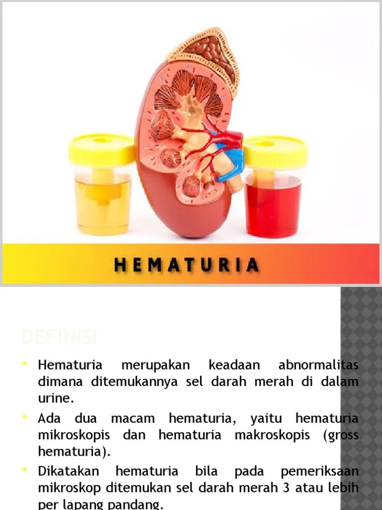 Hematuria Mikroskopis Adalah
