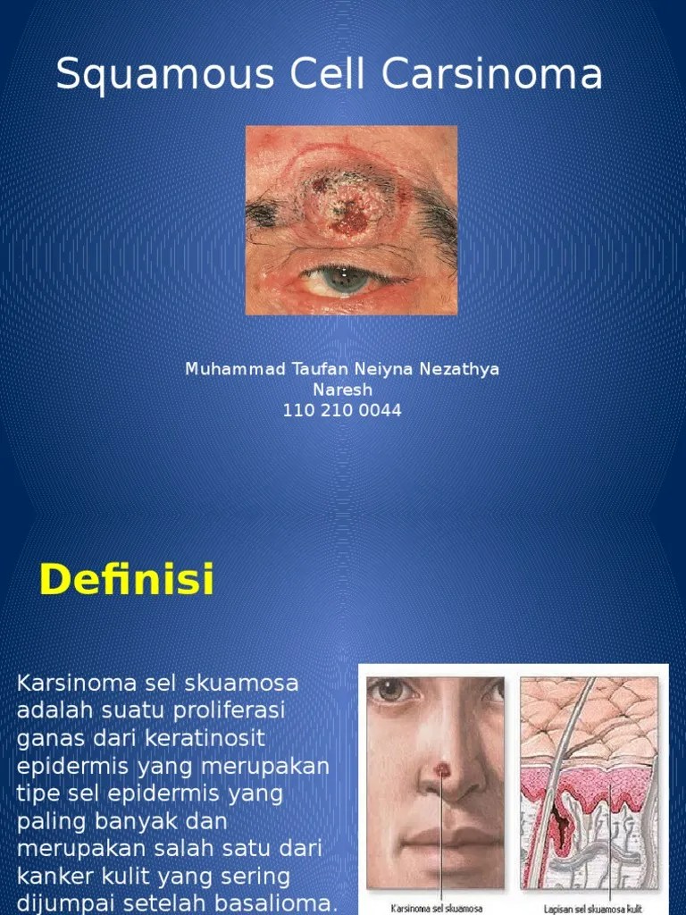 Carsinoma Cell Squamosa | PDF