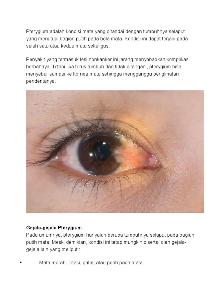 Pterygium | PDF