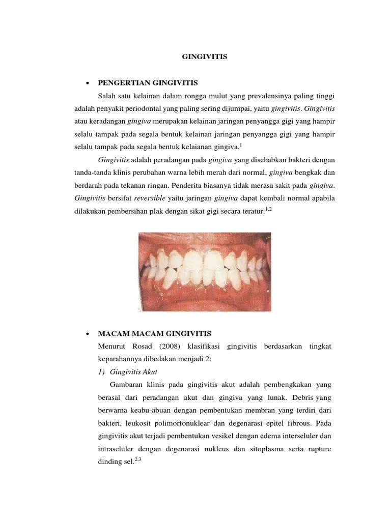 Gingivitis Hem | PDF