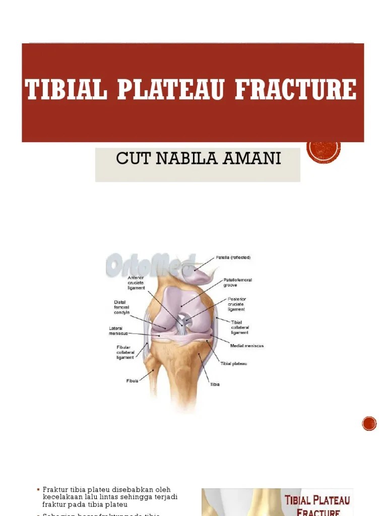 Fraktur Tibia Plateau | PDF