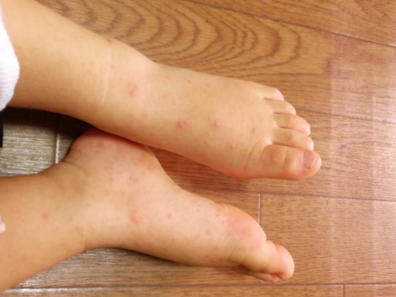 手足口病の症状を解説！手足口病の感染経路や潜伏期間は？手足口病の特徴と注意点や予防法もご紹介します【イシャチョク】