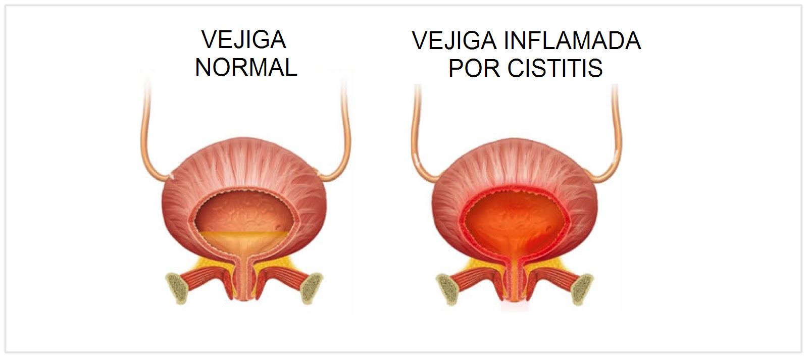 Цистит болячки: почки, мочевой пузырь постила