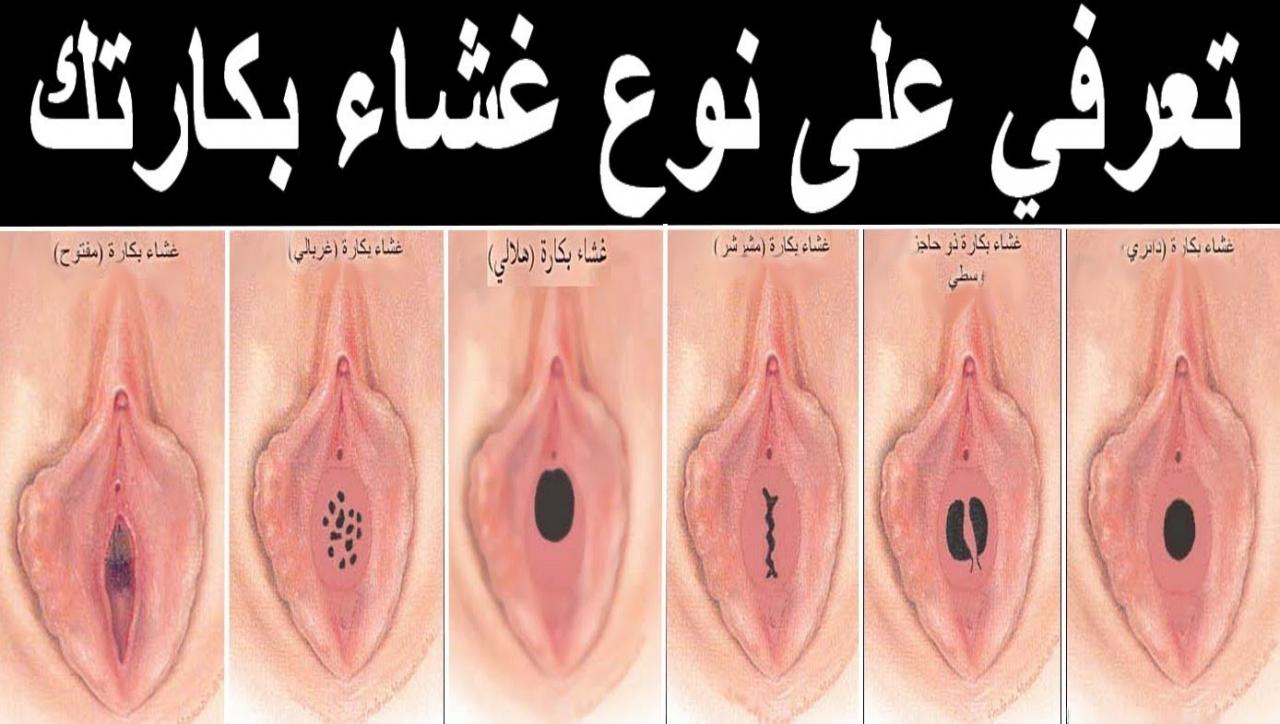 فتح غشاء البكارة