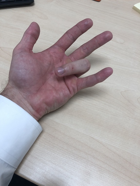 Jari Tangan Kaku Adalah Gejala Trigger Finger, Ini Terapinya - Lamina