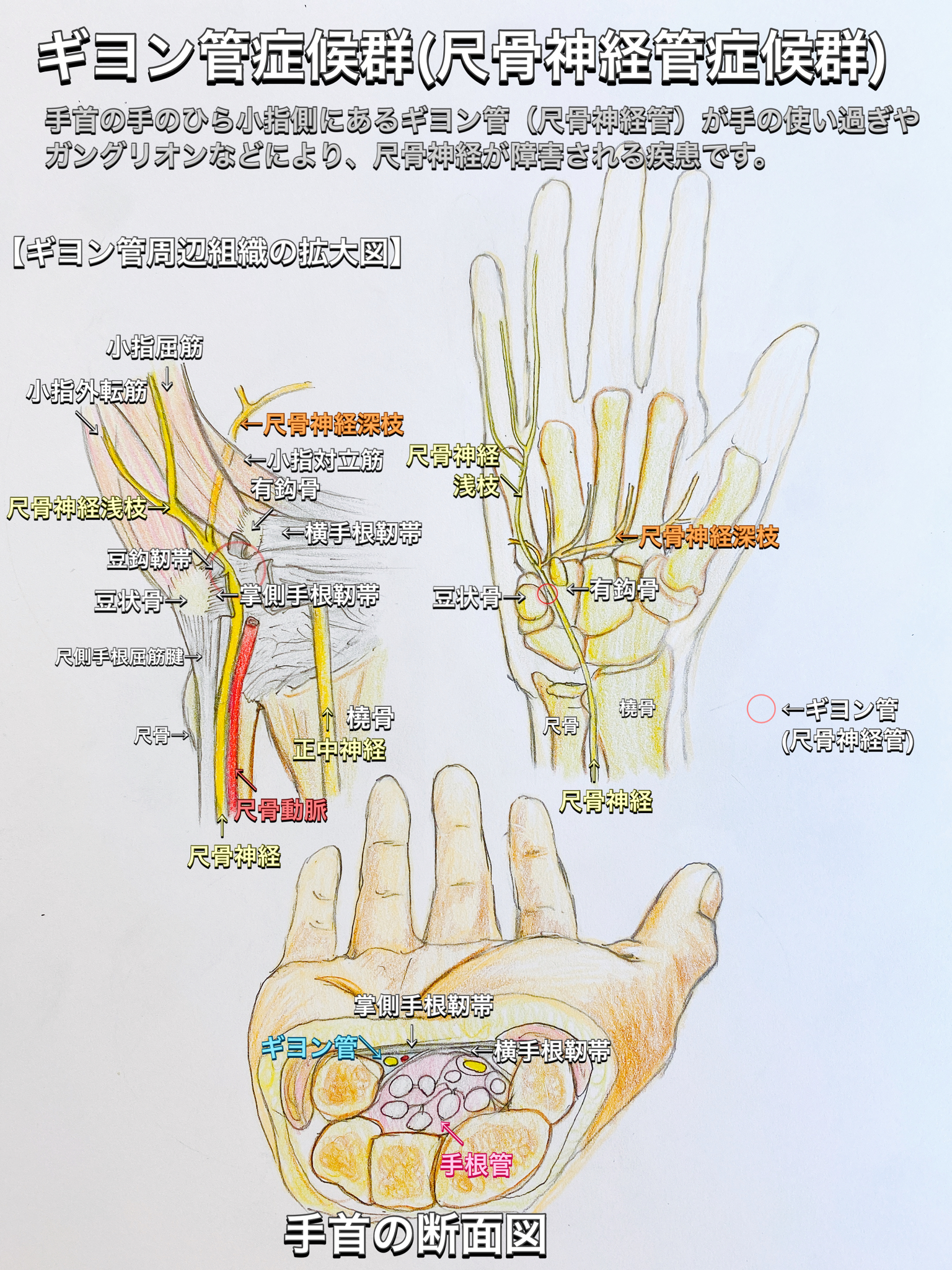 池田市で手指のしびれや痛み、ギヨン管症候群はおまかせ！｜小谷整骨院・鍼灸院