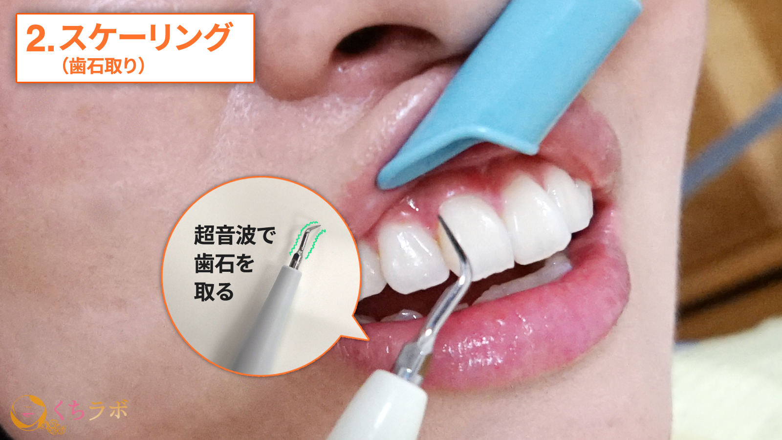 世界の常識！ニッポンの非常識？健康のための「歯のクリーニング」入門