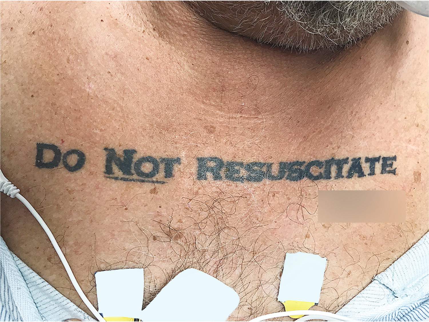 Do Not Resuscitate' Tattoo Creates Medical Dilemma: What Would Australian Doctors Do? - Abc News 575_x_862_jpg