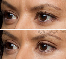 Eye Magic Eye Lift 15 Before And After Using The Eye Magic Flickr