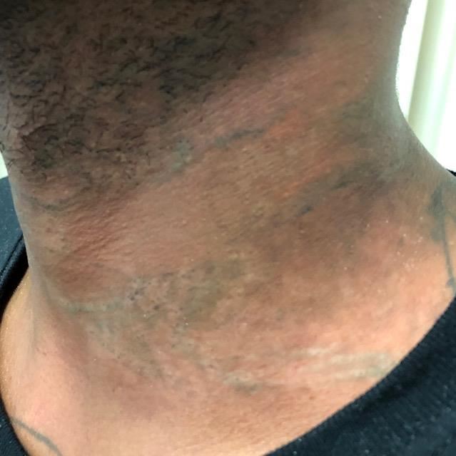 Does Laser Tattoo Removal Work On Dark Skin? 640_x_639_jpg