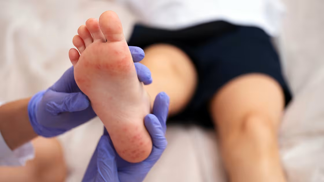 5 Common Skin Rashes Caused by COVID