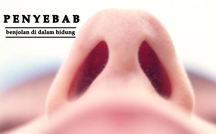 Penyebab Benjolan di Dalam Hidung & Tips Menghilangkannya - Medisweb