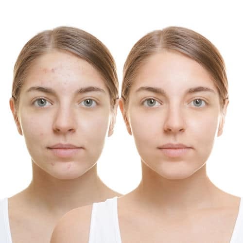 Aspirateur de Points Noirs : avis Dermatologue | by Christine Mallet |  Medium