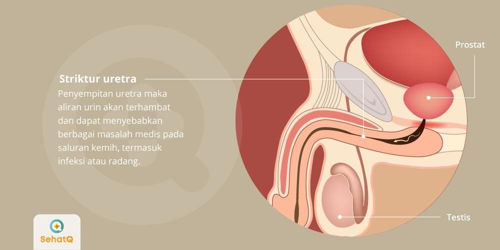 Waspadai Gejala dan Komplikasi Penyempitan Saluran Kencing Akibat Striktur  Uretra | by Sehat Q — Asisten Kesehatan Anda | Medium