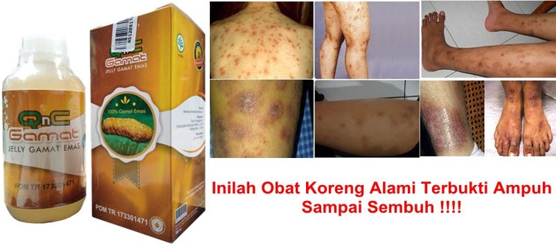 Cara Menghilangkan Bekas Luka Korengan