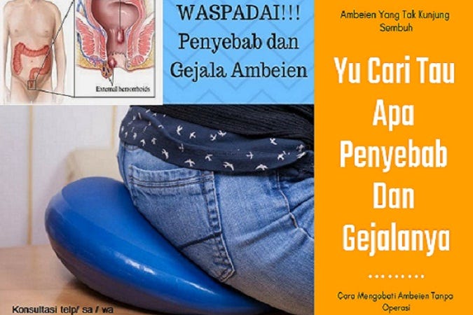 Cara Alami Mengobati Ambeien Setelah Melahirkan | by Cara Mencegah Ambeien  Kambuh | Medium