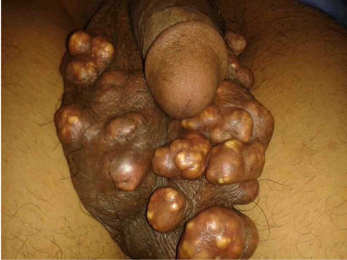 A guide on the subject of 'Untreatable Gonorrhea' | by Dr Ola Brown (Orekunrin) | Medium Gonorrhea porn