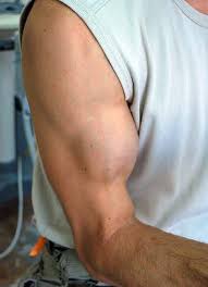 Les pathologies du tendon long biceps - Mon Épaule