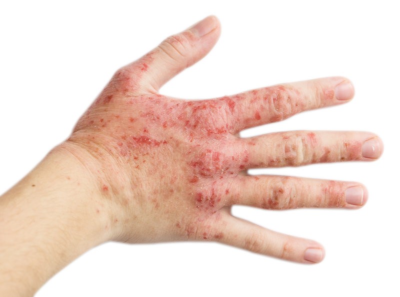 Corso Ecm Fad Gratuito "La Malattia Psoriasica" Per Infermieri E Infermiere Pediatrico | Nurse Times 595_x_800_jpg