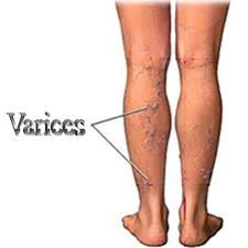 Obat Varises Pada Betis Kaki | Obat Varises pada Betis Kaki