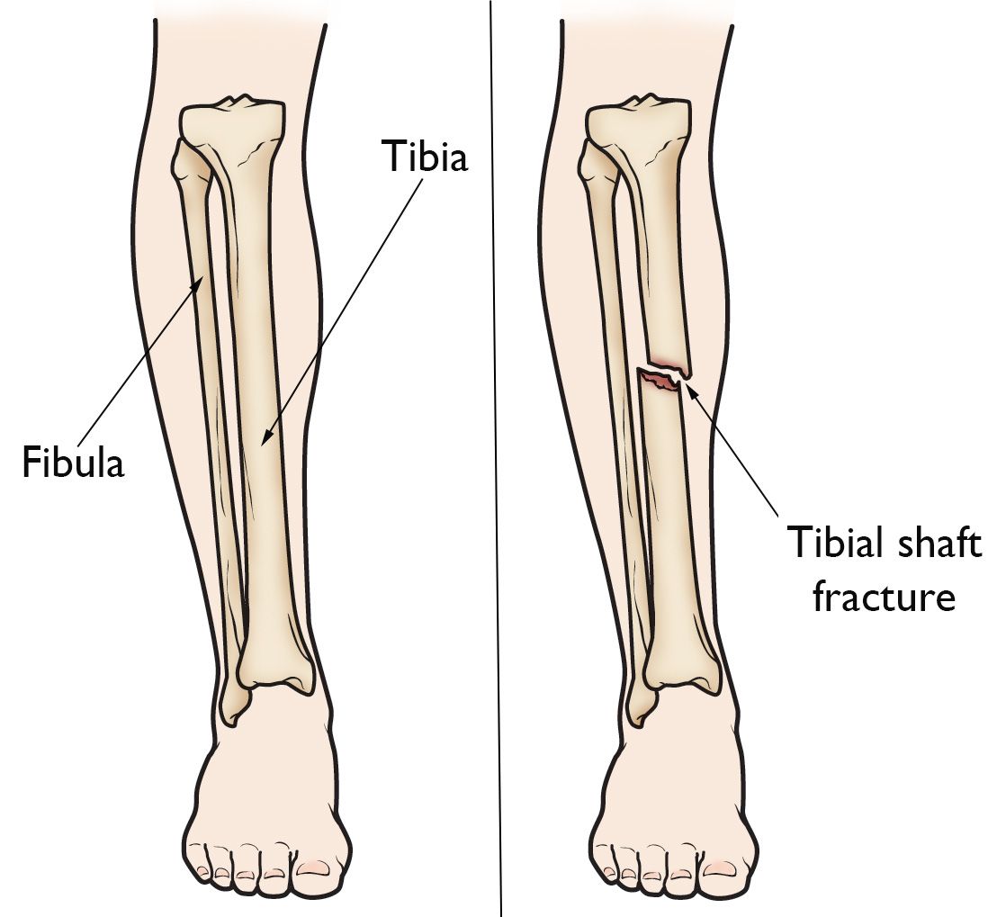 Pic of tibia