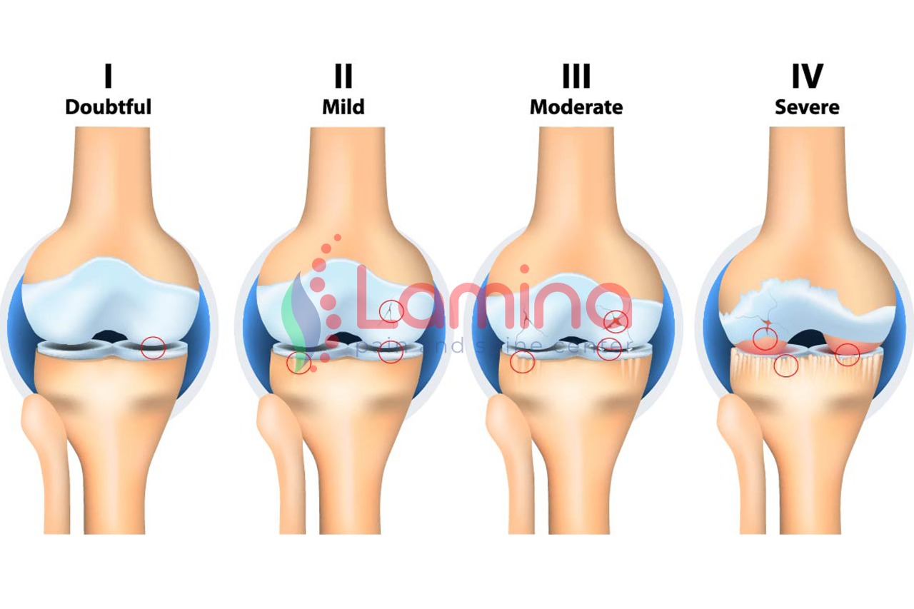 Radang Sendi Lutut, Ketahui Tahapan dan Jenis Obat Anda » Patella