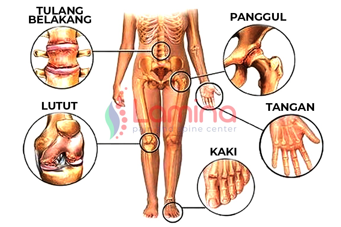 nyeri sendi Archives » Klinik Patella