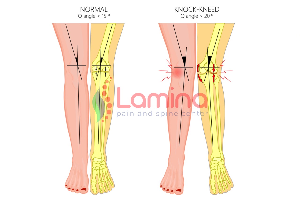 Bentuk Kaki X Pada Orang Dewasa Penyebab dan Dampaknya Apa? » Klinik Patella