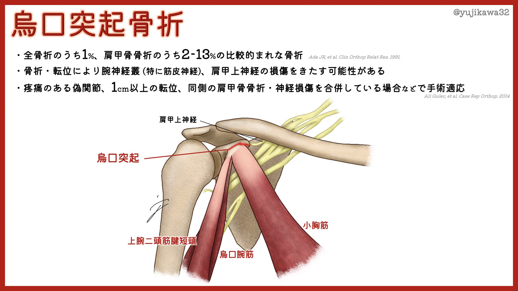 烏口 突起 骨折