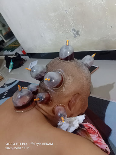Terapi Bekam Sunah Thibbun Nabawi Ponorogo