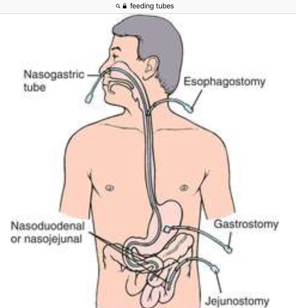 Apa perbedaan antara tabung nasogastrik (nasogastric tube/NGT), selang  makanan (feeding tube) dan selang perut (stomach tube)? Karena fungsi dan  bentuknya berbeda. - Quora