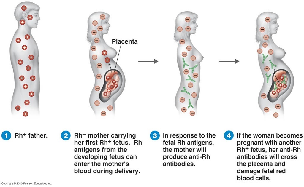 Apakah eritroblastosis fetalis terjadi ketika ibu memiliki Rh+ dan janin  memiliki Rh-ve? - Quora