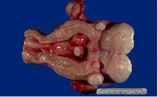 Apa menurut pendapat kalian dengan adanya tumor rahim? Apa itu berbahaya  bagi keselamatan ? - Quora