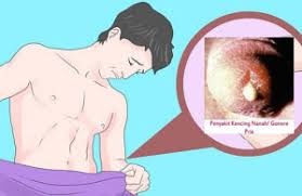 Fungsi Obat Penis Nyeri Saat Buang Air Kecil Bernanah Denature - HERBAL  OBAT DE-NATURE