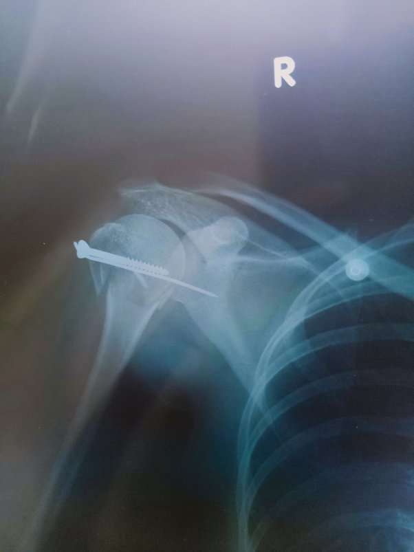 Bagaimana rasanya mengalami patah tulang (kaki/tangan)? Ketika sembuh  adakah perbedaan kinerja dari bagian yang patah tersebut? - Quora