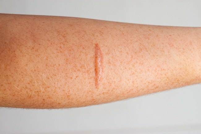 Bagaimana cara menghilangkan keloid yang paling efektif? - Quora