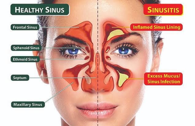 Bagaimana cara mengatasi sinusistis? - Quora