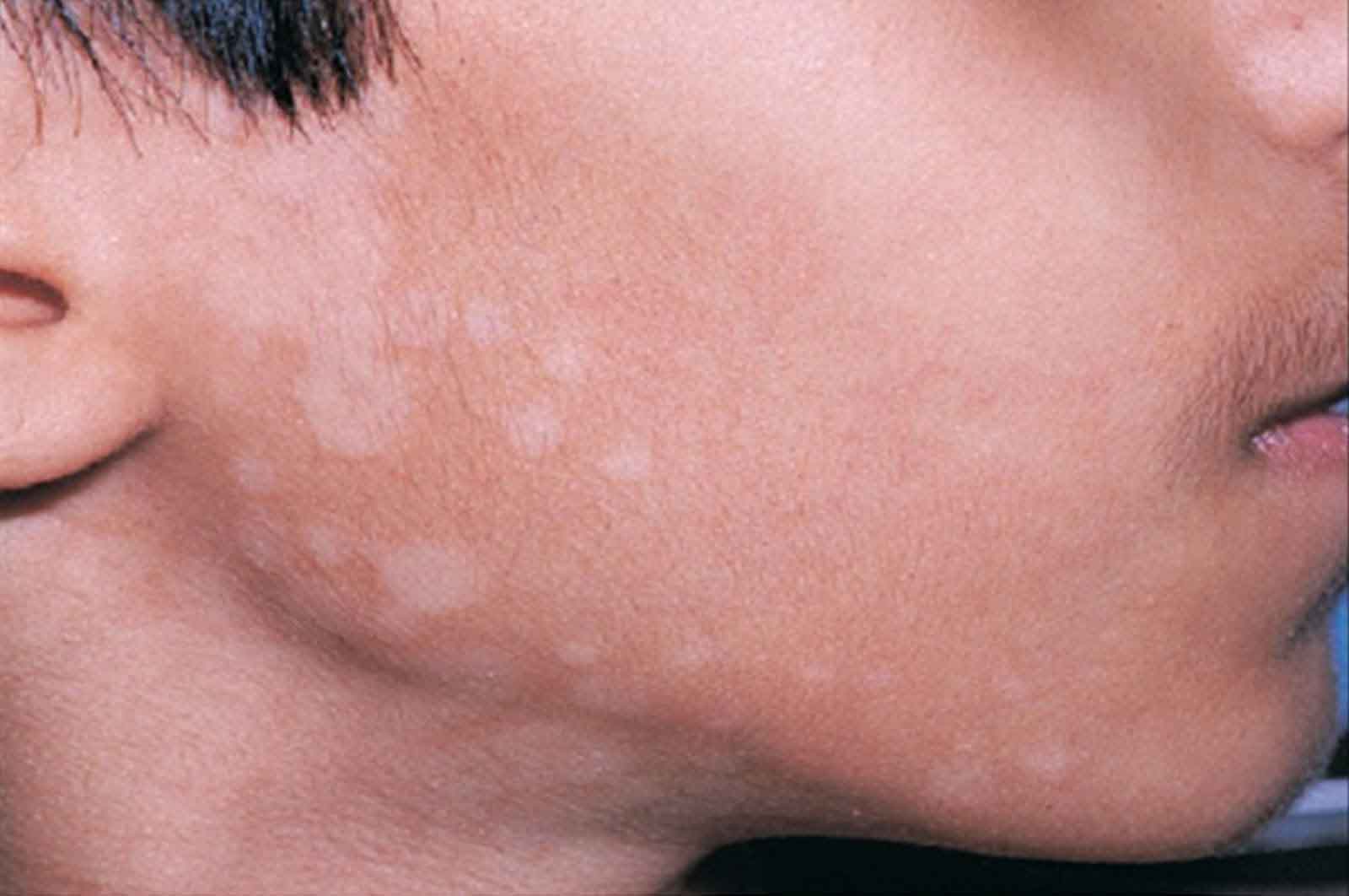 Apa bedanya panu, kadas, dan kurap? - Quora