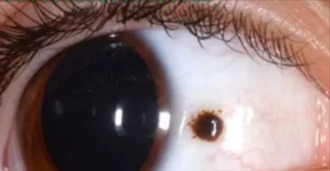 Bagaimana cara menghilangkan bintik kuning di putih mata? - Quora