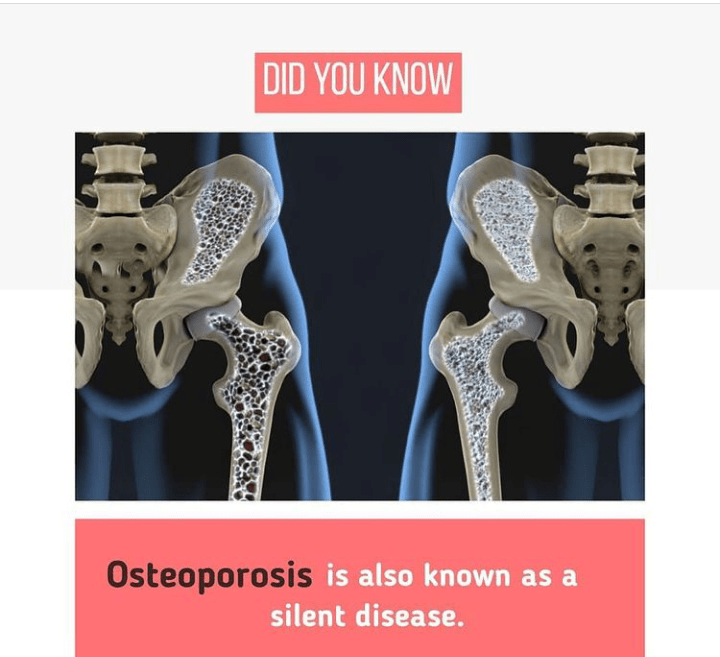 Apa itu osteoporosis? - Quora