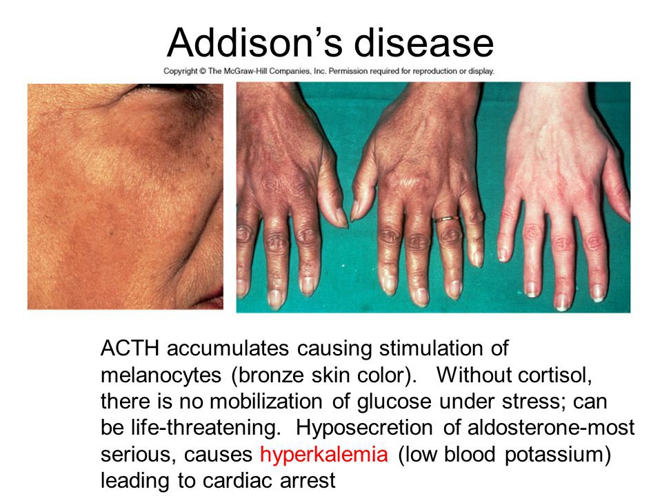 Apa sebenarnya yang menyebabkan kulit menjadi lebih gelap pada penyakit  Addison? - Quora